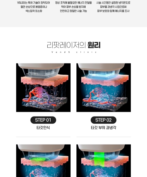 리팟레이저 시술안내 이미지1